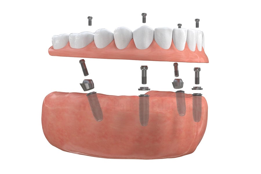 Full Mouth Restoration in Schaumburg, IL