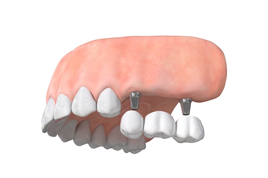 Dental Implant Bridge in Schaumburg, IL