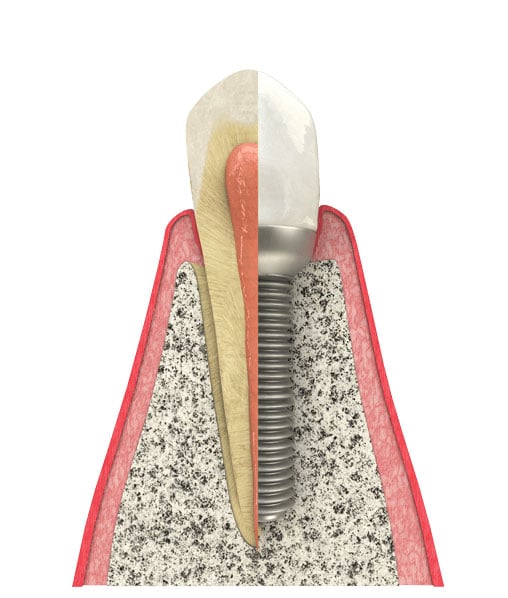 Benefits of Dental Implants in Schaumburg, IL