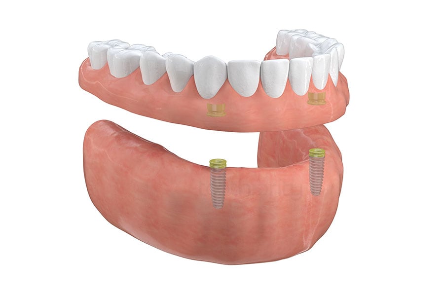 Implant-Supported Overdentures in Schaumburg, IL